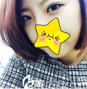 花668元找廈門歐菲苗建國做埋線雙眼皮后擁有閃耀星眼