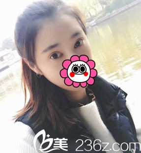 重慶藝星雙眼皮整形術(shù)后7天效果