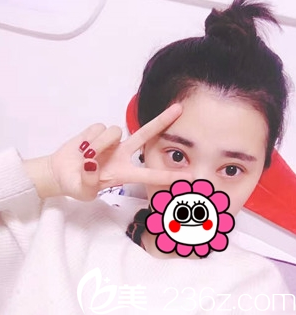 重慶藝星整形雙眼皮術(shù)后1個(gè)月