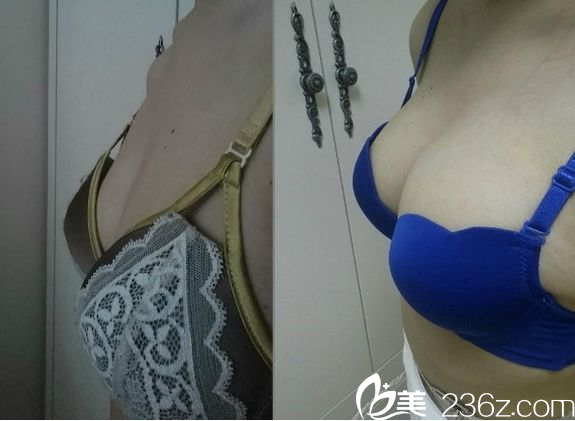 貴陽美萊整形外科醫(yī)院內(nèi)窺鏡豐胸效果