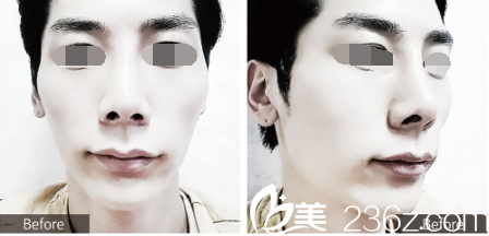 韓國(guó)優(yōu)尼克整形鼻整形面部填充案例 韓國(guó)優(yōu)尼克整形鼻整形面部填充案例