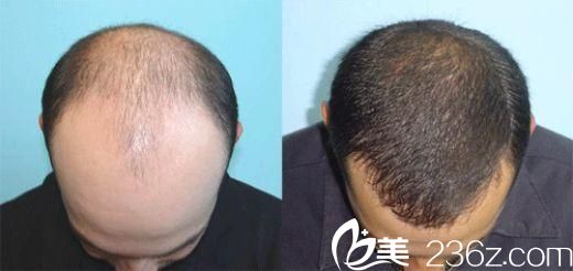 韓國狎鷗亭延世醫(yī)院毛發(fā)移植