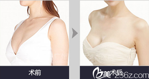 南充韓美整形自體脂肪豐胸案例