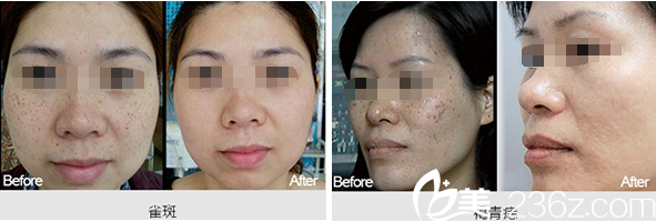 南充韓美整形美容醫(yī)院祛斑案例 南充韓美整形美容醫(yī)院祛斑案例
