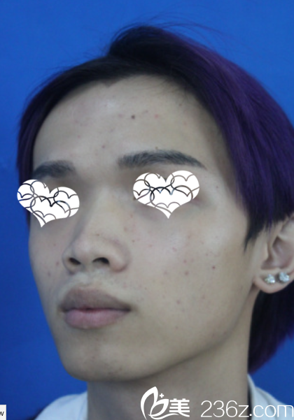 貴陽(yáng)美萊整形外科院長(zhǎng)鼻綜合效果 貴陽(yáng)美萊整形外科院長(zhǎng)鼻綜合效果