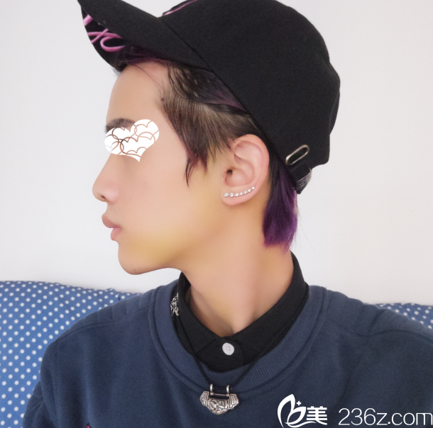 劉照院長(zhǎng)鼻綜合術(shù)后效果 劉照院長(zhǎng)鼻綜合術(shù)后效果