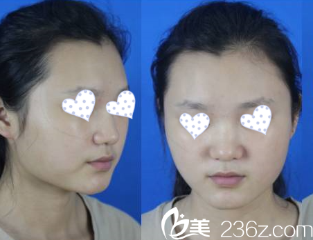 貴陽美萊醫(yī)療美容醫(yī)院隆鼻效果 貴陽美萊醫(yī)療美容醫(yī)院隆鼻效果