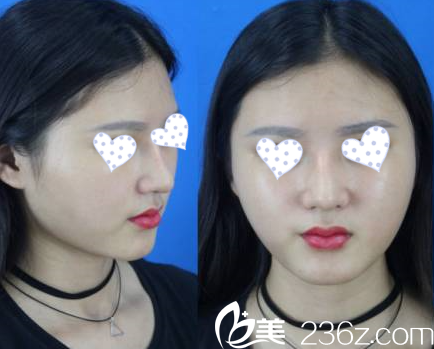 胡院長達(dá)拉斯隆鼻 胡院長達(dá)拉斯隆鼻