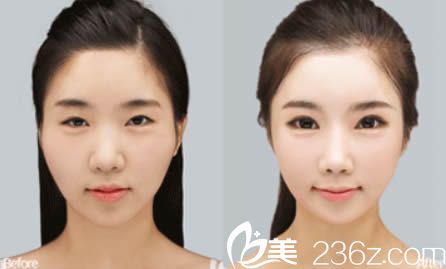 韓美陳誠面部綜合整形效果圖示 韓美陳誠面部綜合整形效果圖示