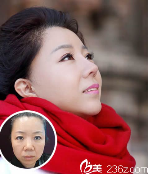 韓美于大山顏面部綜合整形效果圖解