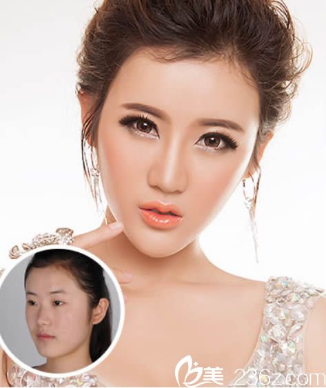 蘭州于大山博士眼部鼻部整形效果展示