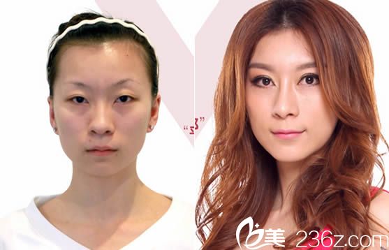 韓美<!--<i data=20240703-sp></i>-->整形效果圖示 韓美<!--<i data=20240703-sp></i>-->整形效果圖示