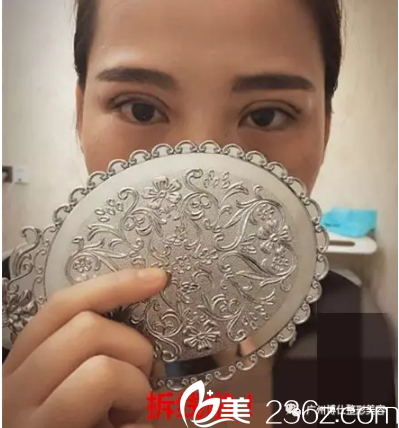 2雙眼皮7天拆線效果