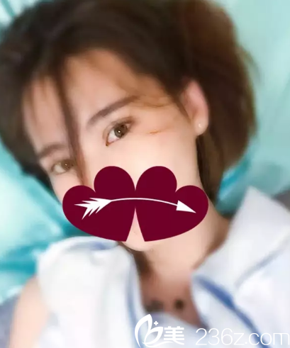 雙眼皮術(shù)后1個月效果