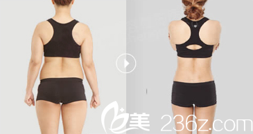 紫潔儷方(北京)醫(yī)療美容診所劉文鋒醫(yī)生吸脂案例 紫潔儷方(北京)醫(yī)療美容診所劉文鋒醫(yī)生吸脂案例