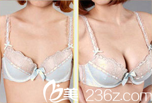 紫潔儷方(北京)醫(yī)療美容診所劉文鋒醫(yī)生自體脂肪豐胸案例 紫潔儷方(北京)醫(yī)療美容診所劉文鋒醫(yī)生自體脂肪豐胸案例