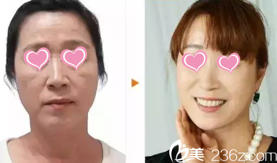 面部年輕化提升術(shù)后效果 面部年輕化提升術(shù)后效果