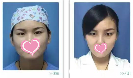 面部輪廓塑形術(shù)后 面部輪廓塑形術(shù)后