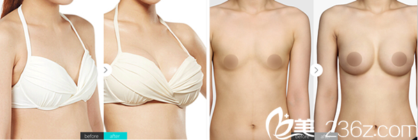 南充五星整形美容醫(yī)院自體脂肪豐胸案例 南充五星整形美容醫(yī)院自體脂肪豐胸案例
