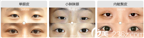 南充五星整形美容醫(yī)院雙眼皮案例錦集