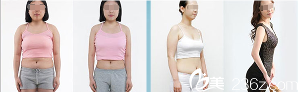 南充五星整形美容醫(yī)院360水動(dòng)力吸脂塑身案例