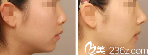 陳先才耳軟骨隆鼻案例