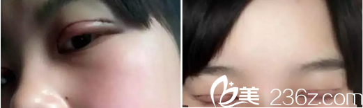 全切雙眼皮術(shù)后2天睜眼閉眼效果