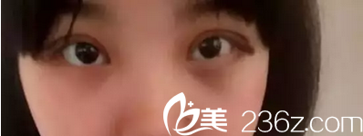 南昌五星全切雙眼皮術(shù)后5天恢復(fù)情況