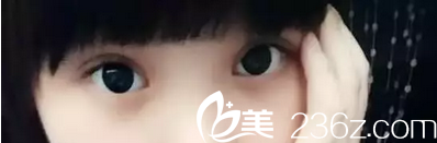 南昌五星全切雙眼皮拆線后效果