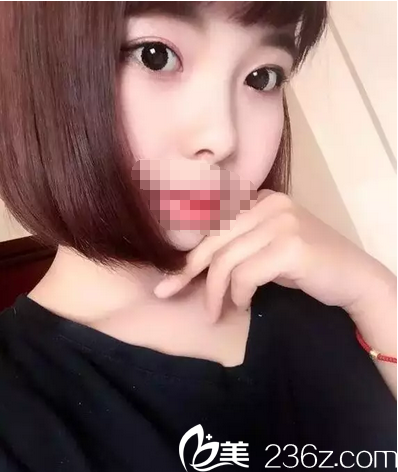 6張照片揭秘我在南充五星做全切雙眼皮從術(shù)前到恢復(fù)的全過程