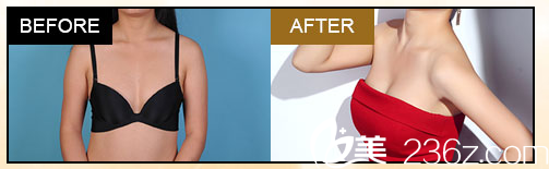 深圳<!--<i data=20240703-sp></i>-->整形科隆胸案例