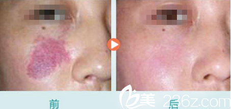 運(yùn)城華美整形劉興芳激光祛胎記 運(yùn)城華美整形劉興芳激光祛胎記