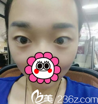 運(yùn)城華美雙眼皮術(shù)前 運(yùn)城華美雙眼皮術(shù)前