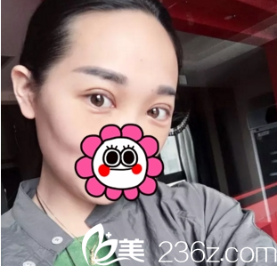 雙眼皮案例術(shù)后10天運(yùn)城華美 雙眼皮案例術(shù)后10天運(yùn)城華美