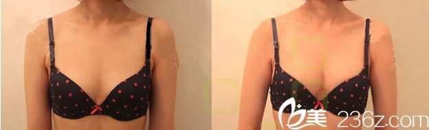 樸泰赫自體脂肪移植豐胸案例 樸泰赫自體脂肪移植豐胸案例