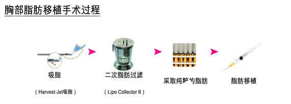 自體脂肪移植豐胸手術(shù)過程 自體脂肪移植豐胸手術(shù)過程