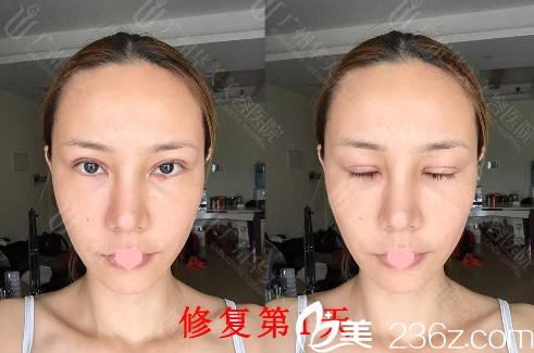 全切雙眼皮修復(fù)天