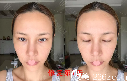 做完全切雙眼皮修復(fù)7天恢復(fù)情況