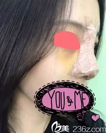 第三天，期待紗布拆掉后的樣子