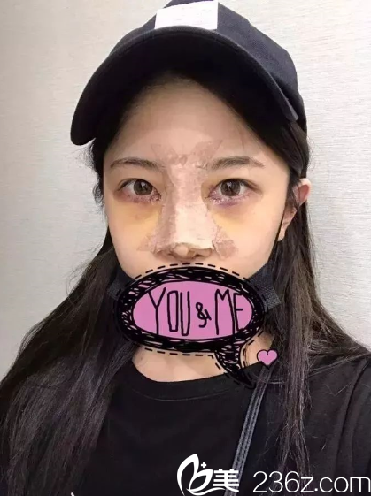 第五天，眼周有點發(fā)青