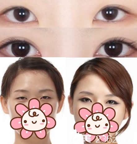 華美<!--<i data=20240703-sp></i>-->眼部整形效果 華美<!--<i data=20240703-sp></i>-->眼部整形效果