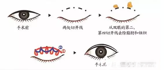 黃金五點(diǎn)翹睫重瞼術(shù)