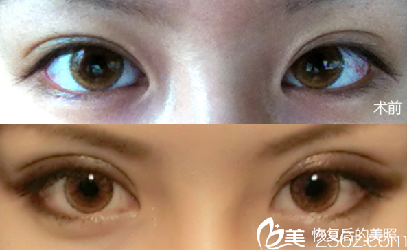 成都星美寶島雙眼皮整形案例