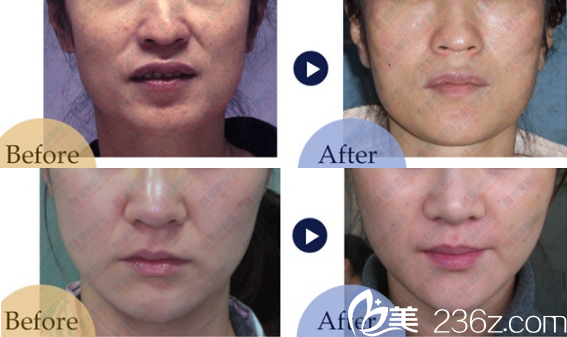 成都星美寶島TBM微創(chuàng)面部提升案例