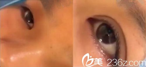 雙眼皮手術(shù)中的照片