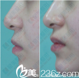 成都星美寶島整形玻尿酸填充案例 成都星美寶島整形玻尿酸填充案例