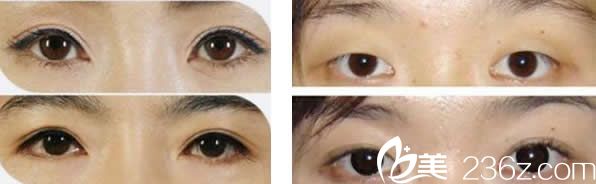 范志宏雙眼皮整形前后 范志宏雙眼皮整形前后