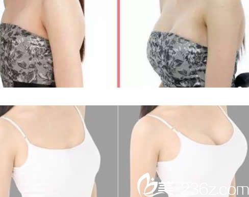 華美亓發(fā)芝隆胸效果對比 華美亓發(fā)芝隆胸效果對比