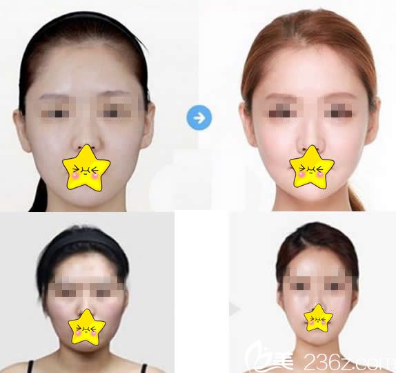 華美王志軍面部整形效果 華美王志軍面部整形效果
