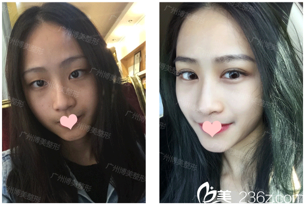 廣州星團(tuán)（原博美）整形醫(yī)院雙眼皮案例